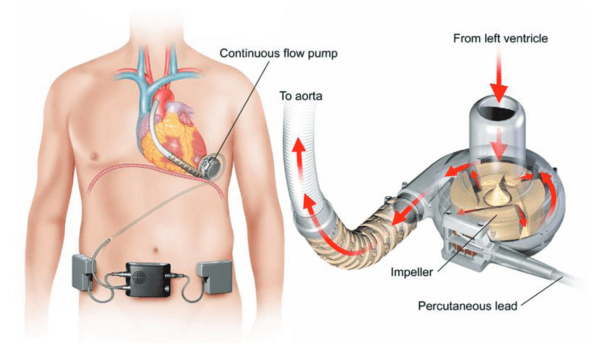 Ventricular Assist Devices Market Report 2022-2027